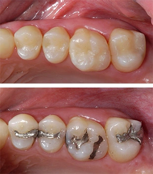 axel-composite-fillings