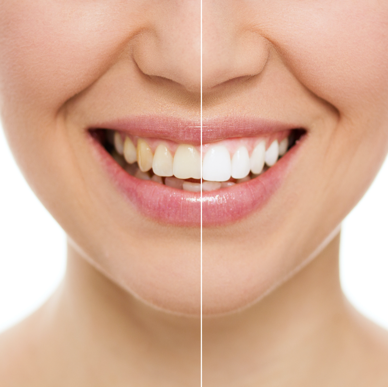 teeth-whitening-image